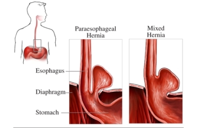 Hernia hiatal