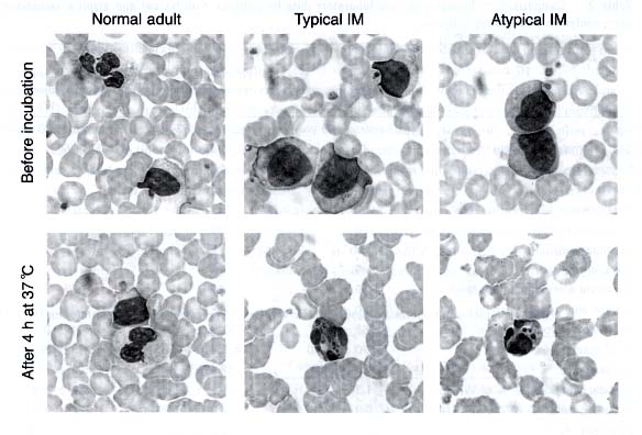 Figure 1. Representative peripheral blood smears from a healthy subject, a patient with typical infectious mononucleosis (IM), and a patient with atypical IM associated with primary Epstein-Barr viru s infection immediately after blood was taken or after 4 h of incubation at 37 Celsius. May-Grunwald-Giemsa stain; original magnification, x 1000. 86n1.jpg