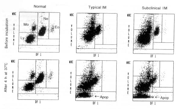 Figure 2. Representative blood scattergrams of anticoagulated peripheral blood samples obtained from a healthy subject, a patient with Epstein-Barr virus--associated acute infectious mononucleosis (typical IM), and a patient with upper respiratory tract infection and serological evidence of primary Epstein-Barr virus infection (atypical IM), subjected to automated hematologic analysis with the MAXM analyzer (Beckman-Coulter) either immediately after blood was drawn or after 4 h of incubation at 37 Celsius. Ly, lymphocytes; Mo, monocytes; Ne, neutrophils; Eo, eosinophils; Apop, apoptotic cell cluster. 87n1.jpg